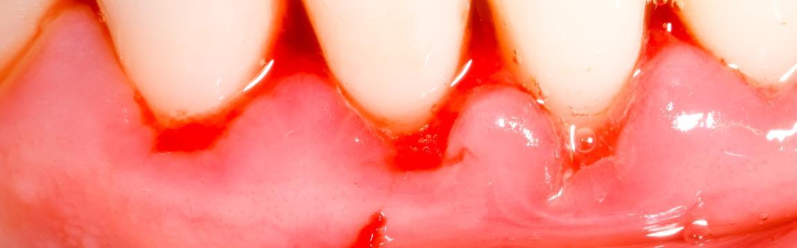 Mouth Cuts - Mouth Lacerations - University Dental Center